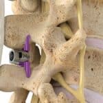 علائم تنگی کانال نخاعی کمر و بهبود با فریدام فوراور