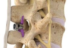 علائم تنگی کانال نخاعی کمر و بهبود با فریدام فوراور