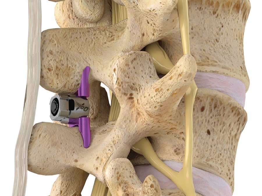 علائم تنگی کانال نخاعی کمر و بهبود با فریدام فوراور